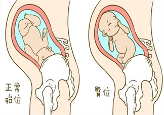胎位不正只能剖腹產(chǎn)了嗎 怎么讓胎位不正順產(chǎn)