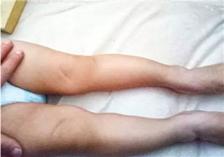 嬰兒為什么是青蛙腿 寶寶青蛙腿用不用綁腿