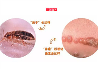 寶寶被臭蟲咬了癥狀圖片 寶寶被臭蟲咬和蚊子咬癥狀對(duì)比圖片區(qū)別