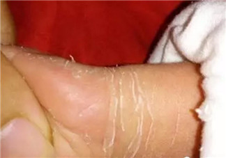 新生兒手腳脫皮要多久 新生兒脫皮怎么護理(能搽點什么)