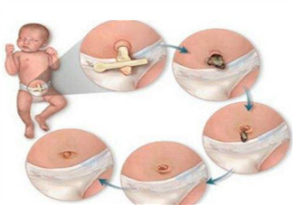 新生兒臍帶消毒用什么 臍帶消毒用碘伏好還是酒精(肚臍消毒圖解)