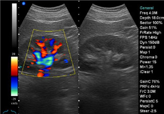 b超和彩超的區(qū)別 什么情況下使用普通B超或彩超