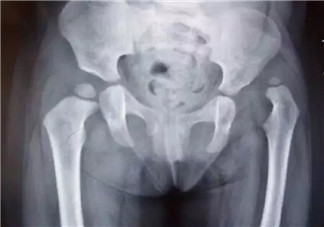 寶寶臀紋不對稱怎么回事 臀紋不對稱一定是髖關(guān)節(jié)發(fā)育不良嗎